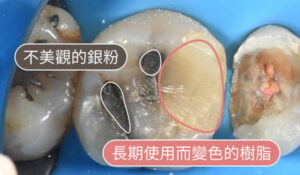 耘禾牙醫 – 有不合時宜的填補物者