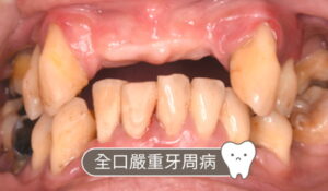 耘禾牙醫 – 無法適應活動假牙