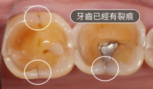 耘禾牙醫 – 牙齒已產生裂痕，但尚未傷及神經及牙根者