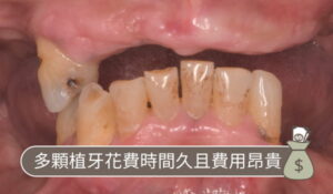 耘禾牙醫 – 缺牙數量過多