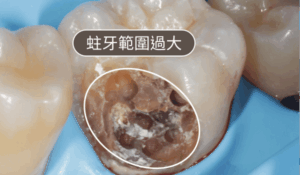 耘禾牙醫 – 蛀牙範圍過大者