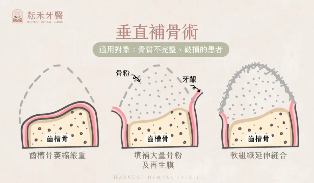 耘禾牙醫-補肉手術