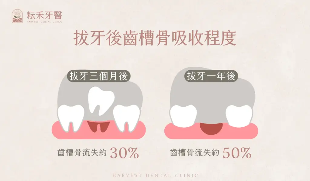 耘禾牙醫-齒槽骨保存術