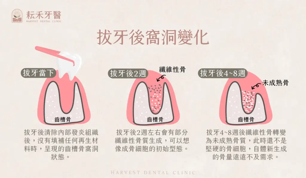 耘禾牙醫-齒槽骨保存術