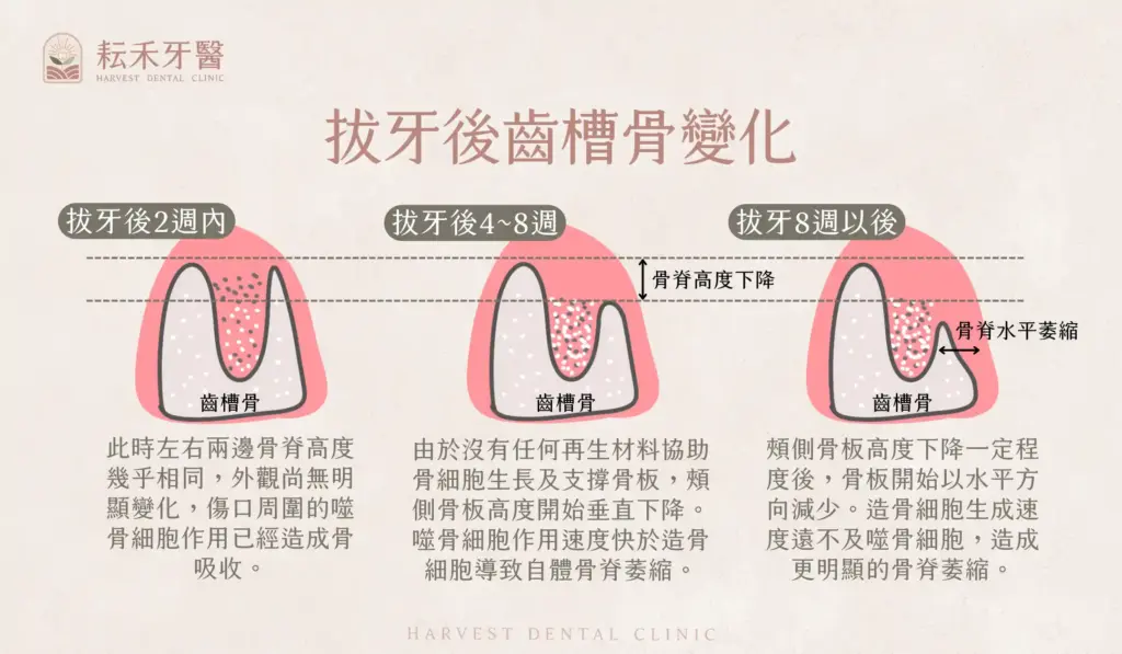 耘禾牙醫-齒槽骨保存術