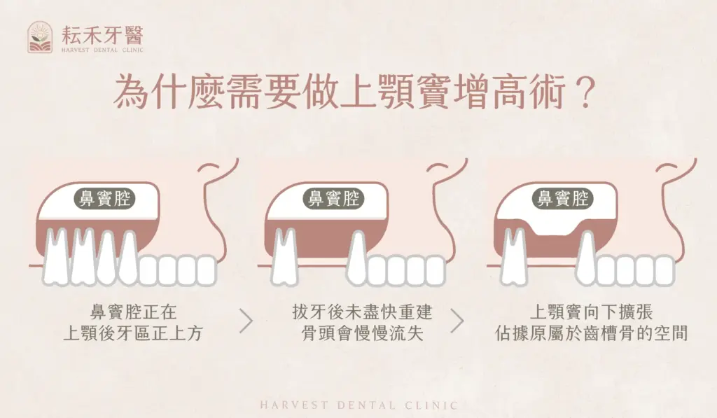 耘禾牙醫-上顎竇增高術