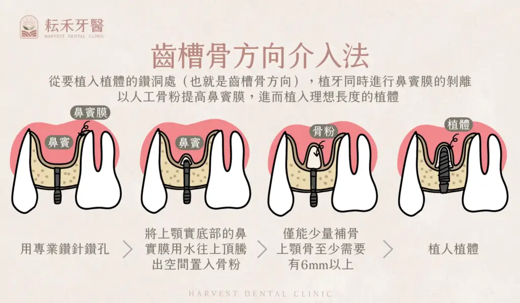 耘禾牙醫-上顎竇增高術
