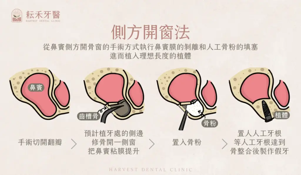 耘禾牙醫-上顎竇增高術